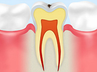 初期の虫歯（C0）
